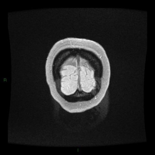 File:Cerebellar abscess (Radiopaedia 78135-90678 Coronal T1 C+ 167).jpg