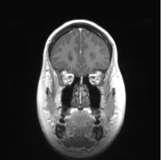Cerebellar ependymoma complicated by post-operative subdural hematoma (Radiopaedia 83322-97736 Coronal T1 C+ 13).png