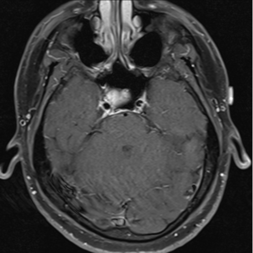 File:Cerebellar hemangioblastomas and pituitary adenoma (Radiopaedia 85490-101176 Axial T1 C+ fat sat 13).png