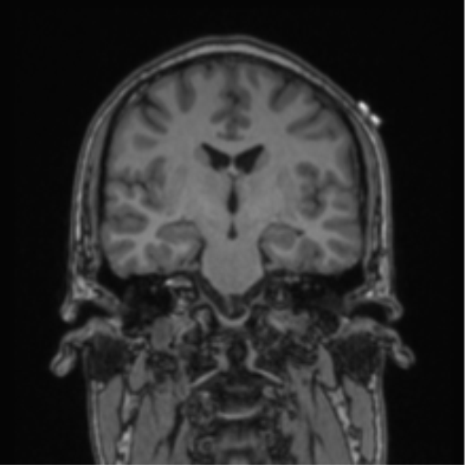 Cerebellar hemangioblastomas and pituitary adenoma (Radiopaedia 85490-101176 Coronal T1 48).png