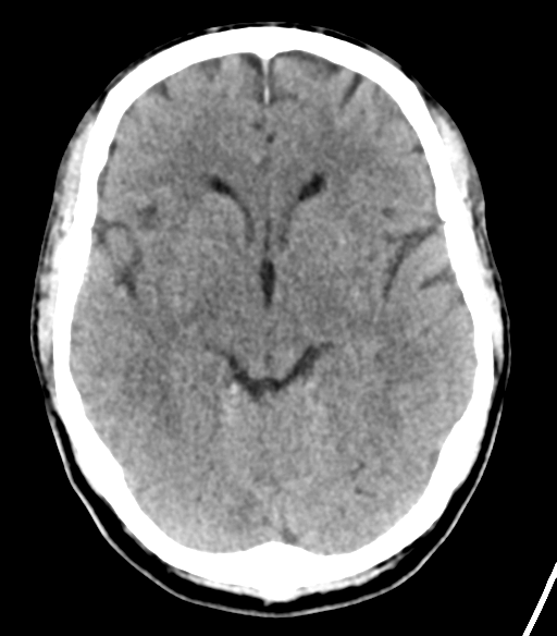 File:Cerebellar hemorrhage (Radiopaedia 37000-38669 Axial non-contrast 18).png