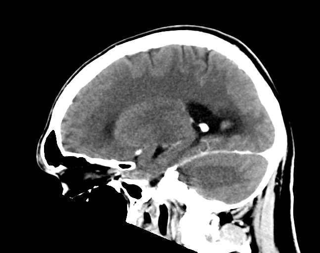 File:Cerebellar hemorrhage (Radiopaedia 37000-38671 Sagittal C+ 23).png