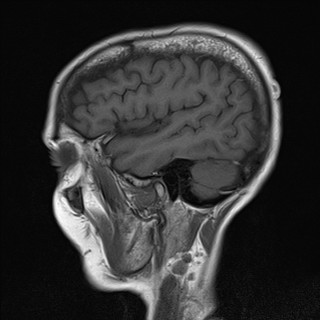 File:Cerebellar metastases (Radiopaedia 24038-24249 Sagittal T1 15).jpg
