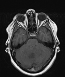 File:Cerebellar metastasis (Radiopaedia 54578-60810 Axial T1 12).png