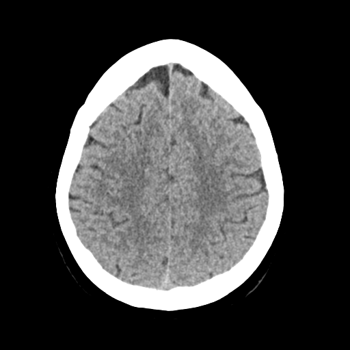 File:Cerebellar metastasis (Radiopaedia 54578-60812 Axial non-contrast 38).png