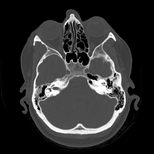 Cerebellar metastasis (cystic appearance) (Radiopaedia 41395-44258 Axial bone window 15).png