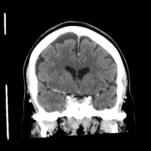 Cerebellar metastasis (cystic appearance) (Radiopaedia 41395-44258 D 26).png