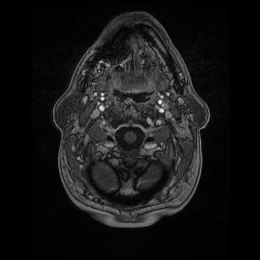 Cerebellar metastasis of pulmonary adenocarcinoma, cavernous venous malformation, and developmental venous anomaly (Radiopaedia 85827-101661 Axial T1 C+ 10).jpg