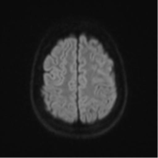Cerebellar tuberculomas (Radiopaedia 46939-51472 Axial DWI 51).png