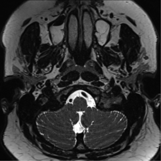 Cerebellopontine angle meningioma (Radiopaedia 48434-53348 Axial T2 Space 13).png
