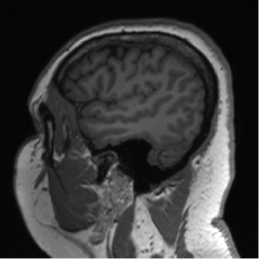 Cerebellopontine angle meningioma (Radiopaedia 48434-53348 Sagittal T1 73).png