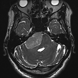 File:Cerebellopontine angle meningioma (Radiopaedia 72983-83680 Axial FIESTA 34).jpg