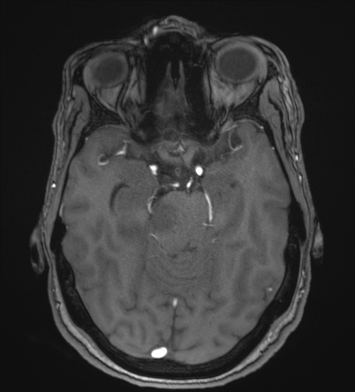 Cerebellopontine angle meningioma (Radiopaedia 72983-83680 Axial MRA 46).jpg