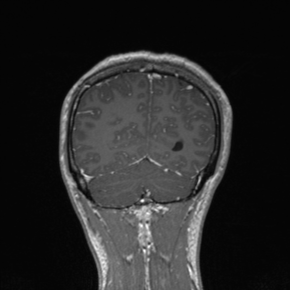 Cerebral abscess (Radiopaedia 24212-24478 Coronal T1 C+ 164).jpg
