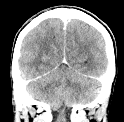 Cerebral abscess (Radiopaedia 60342-68008 Coronal C+ delayed 49).png