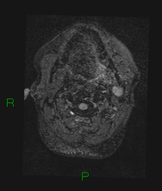 Cerebral abscess and subdural empyema (Radiopaedia 84436-99779 Axial FLAIR 85).jpg