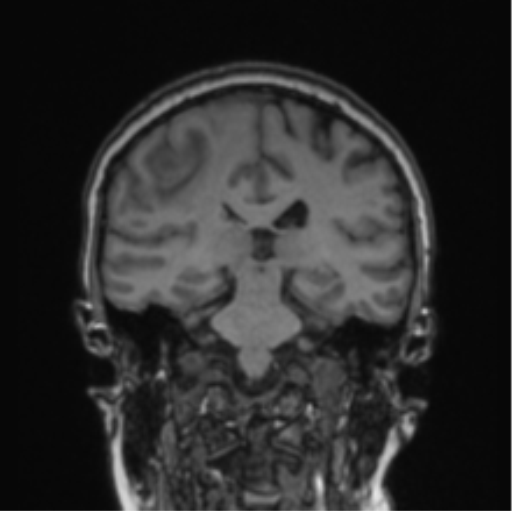 File:Cerebral abscess from pulmonary arteriovenous malformation (Radiopaedia 86275-102291 Coronal T1 40).png