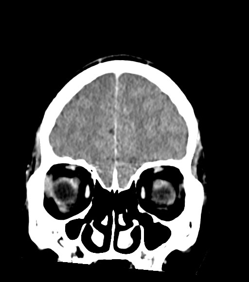 Cerebral abscesses (Radiopaedia 70458-80568 Coronal Contrast 15).jpg