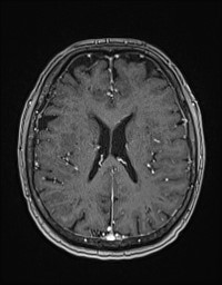 Cerebral amyloid angiopathy-related inflammation (Radiopaedia 58270-65377 Axial T1 C+ fat sat 90).jpg