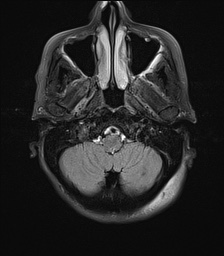 File:Cerebral amyloid angiopathy-related inflammation (Radiopaedia 74836-85849 Axial FLAIR 5).jpg