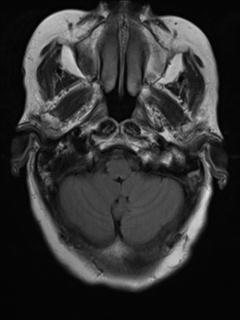 File:Cerebral amyloid angiopathy (Radiopaedia 29129-29518 Axial FLAIR 3).jpg