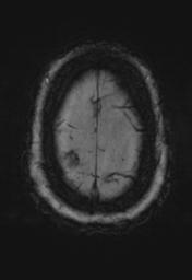 File:Cerebral amyloid angiopathy (Radiopaedia 29129-29518 Axial SWI MPR 34).jpg