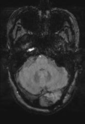 File:Cerebral amyloid angiopathy (Radiopaedia 29129-29518 Axial SWI Magnitude 7).jpg
