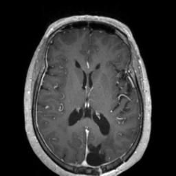 Cerebral amyloid angiopathy (Radiopaedia 29129-29518 Axial T1 C+ 83).jpg