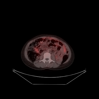 Cerebral and abdominal tuberculosis (Radiopaedia 90499-107853 C 176).jpg