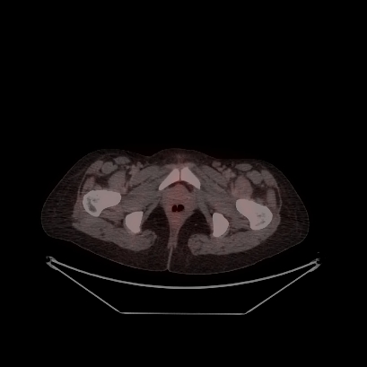 Cerebral and abdominal tuberculosis (Radiopaedia 90499-107853 C 242).jpg