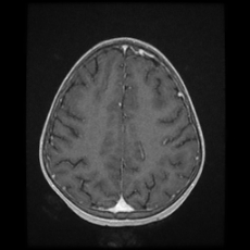Cerebral and spinal tuberculosis (Radiopaedia 90489-107837 Axial T1 C+ 140).jpg