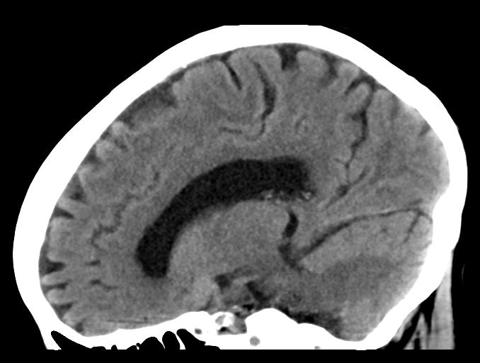 File:Cerebral aneurysm with rupture (Radiopaedia 29933-30457 B 13).jpg