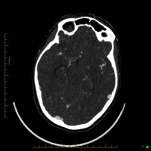 Cerebral arteriovenous malformation (AVM) (Radiopaedia 78162-90706 Axial CTA 122).jpg
