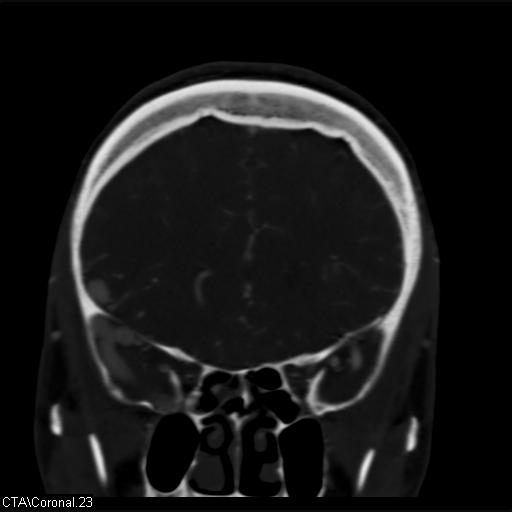 File:Cerebral arteriovenous malformation (Radiopaedia 28518-28759 C 23).jpg