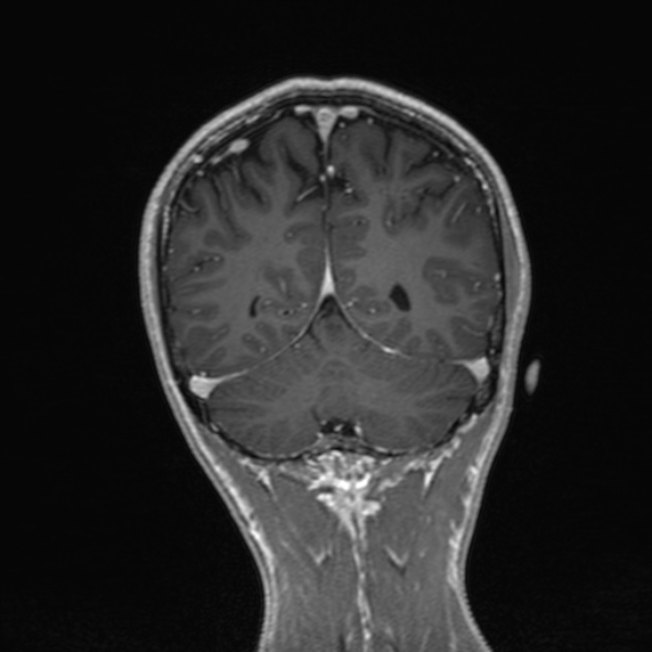 Cerebral arteriovenous malformation (Radiopaedia 30198-30813 F 44).jpg