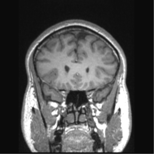 Cerebral arteriovenous malformation (Radiopaedia 39259-41506 Coronal T1 66).png
