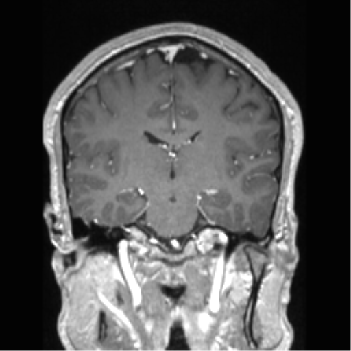 Cerebral arteriovenous malformation (Radiopaedia 39259-41506 Coronal T1 C+ 46).png