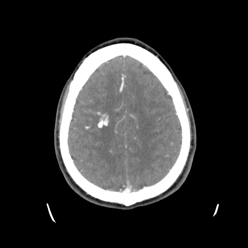 Cerebral arteriovenous malformation (Radiopaedia 55798-62371 B 39).png