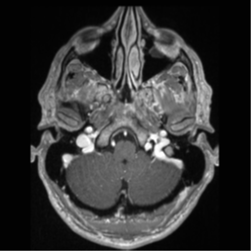 Cerebral arteriovenous malformation (Radiopaedia 55798-62372 Axial T1 C+ 11).png
