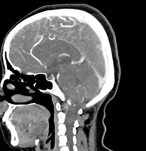 Cerebral arteriovenous malformation (Radiopaedia 73830-84645 D 45).jpg