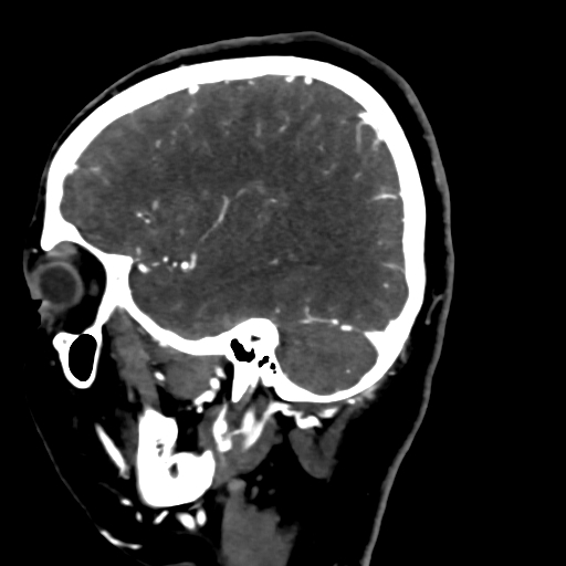Cerebral arteriovenous malformation (Radiopaedia 73830-84645 Sagittal C+ delayed 23).jpg