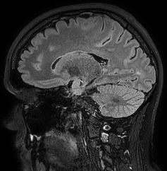 Cerebral arteriovenous malformation (Radiopaedia 74411-85654 Sagittal FLAIR 47).jpg