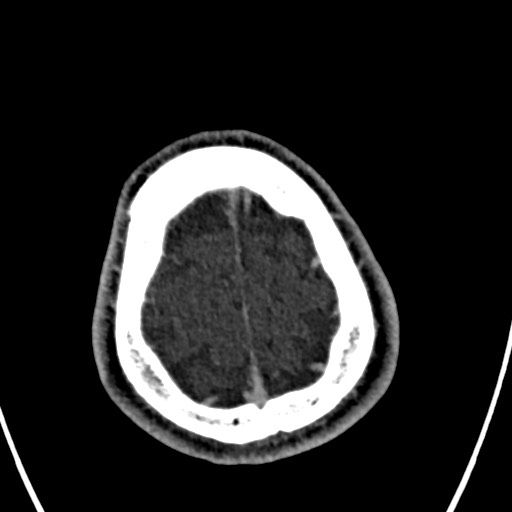Cerebral arteriovenous malformation (Radiopaedia 78188-90746 Axial C+ delayed 154).jpg