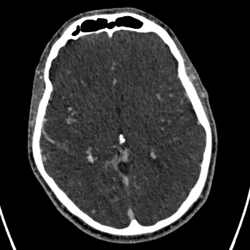Cerebral arteriovenous malformation (Radiopaedia 78188-90746 Axial C+ delayed 85).jpg