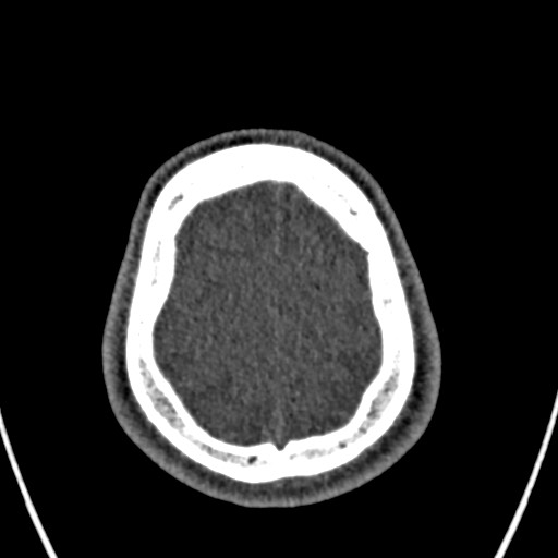 Cerebral arteriovenous malformation (Radiopaedia 78188-90746 Axial non-contrast 158).jpg