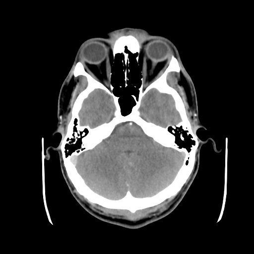 Cerebral arteriovenous malformation (Spetzler-Martin grade 2) (Radiopaedia 41262-44076 Axial C+ 13).png