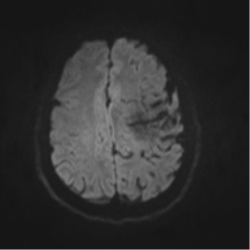 File:Cerebral arteriovenous malformation - huge (Radiopaedia 35734-37272 Axial DWI 40).png