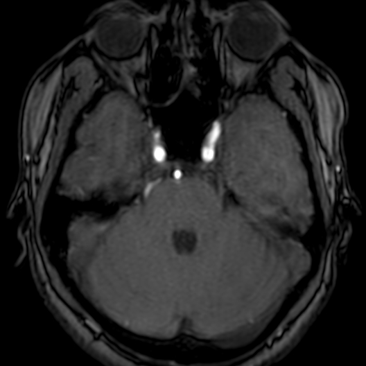 Cerebral arteriovenous malformation at posterior body of corpus callosum (Radiopaedia 74111-84925 Axial MRA 55).jpg