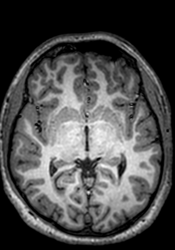 Cerebral arteriovenous malformation at posterior body of corpus callosum (Radiopaedia 74111-84925 Axial T1 161).jpg