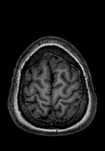 File:Cerebral arteriovenous malformation at posterior body of corpus callosum (Radiopaedia 74111-84925 Axial T1 20).jpg